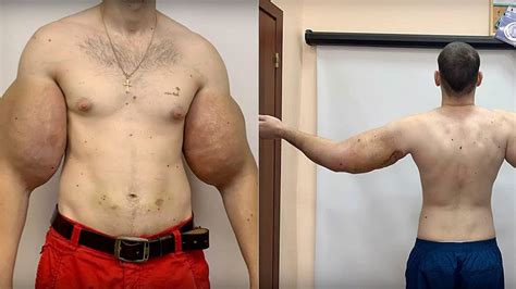 Russian 'Popeye' has 3 pounds of 'dead' muscle removed after DIY bodybuilding injections | FOX ...