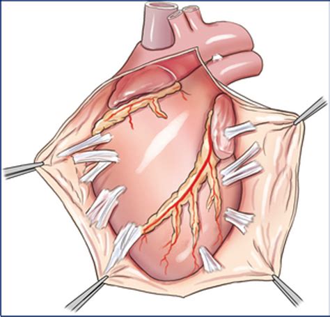 Pericardial Diseases | Dr Krasopoulos