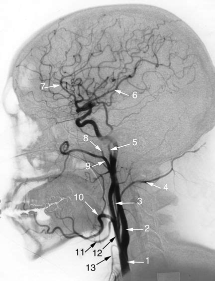 Angiogram of the head: Common Carotid Artery. Internal Carotid Artery ...