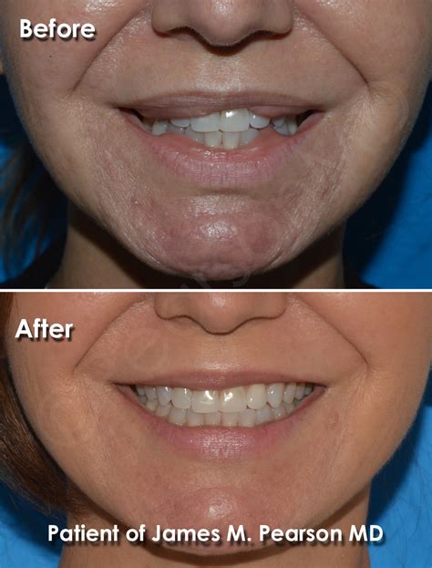 Lip Reduction Photos - Before & After - Dr. James Pearson Facial Plastic Surgery