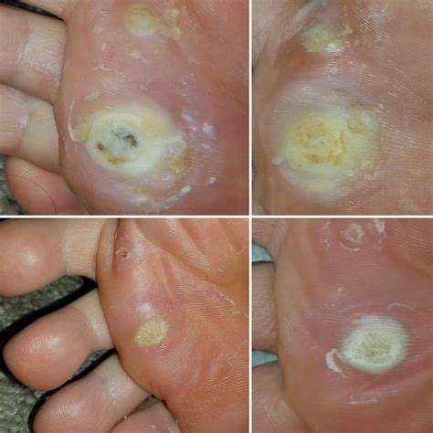 You asked. Here is my Plantar Wart progression : r/popping