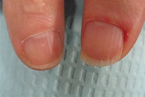 Onycholysis — Dr. Dana Stern | Dermatologist | Nail Specialist