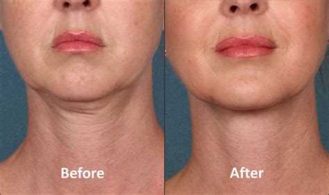 Non Invasive Neck Lift for Double Chin Removal | Cosmetique, NY