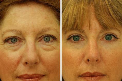 How Much Does Eye Bag Removal Cost
