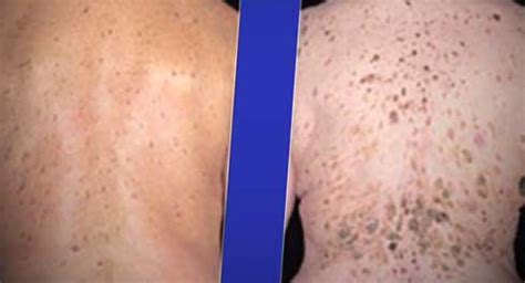 Brown Spots On Skin Causes