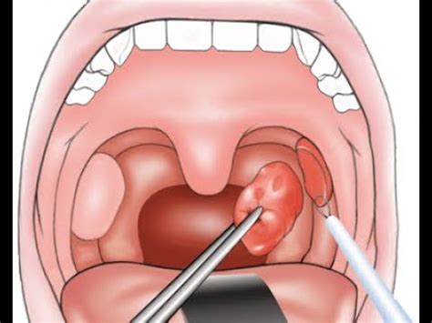 ADENOTONSILLECTOMY - INTRODUCTION | ADENOTONSILLECTOMU & TONSILLECTOMY | PROCEDURE - YouTube