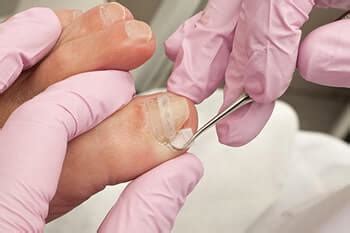 Ingrown Toenails Treatment | Podiatrist, Foot Doctor Hallandale Beach ...