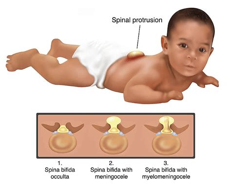 Advancements in Spina Bifida Treatment: Paving the Way for Improved ...