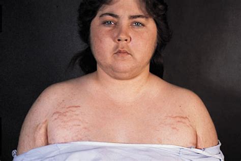 Cushing’s Syndrome (Hypercortisolism): Symptoms, Causes and Treatment ...