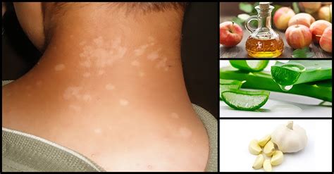 Effective Home Remedies To Treat Tinea Versicolor (An-An) - Dr. Farrah MD