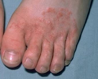 Foot Rash: Causes, Symptoms & Treatment (2023)