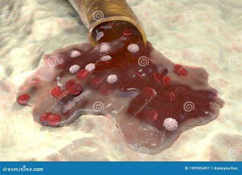 Blood flow, hemorrhage stock illustration. Illustration of biology ...