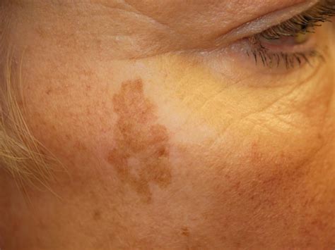 Can Age Spots Be Raised? Exploring The Truth Behind Skin Bumps