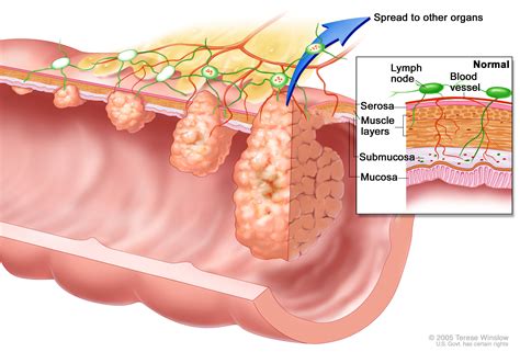 Colon Cancer Stages And Treatment