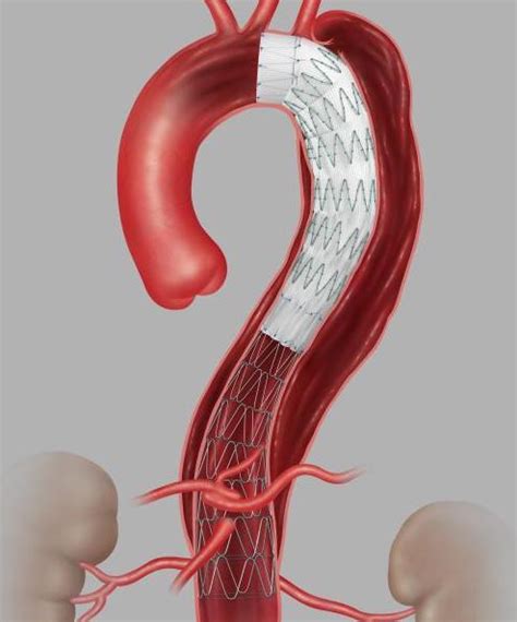 Vascular stents & grafts - Questions and Answers in MRI