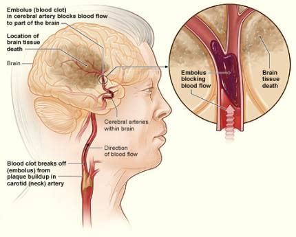 Stroke - Causes and Risk Factors | NHLBI, NIH