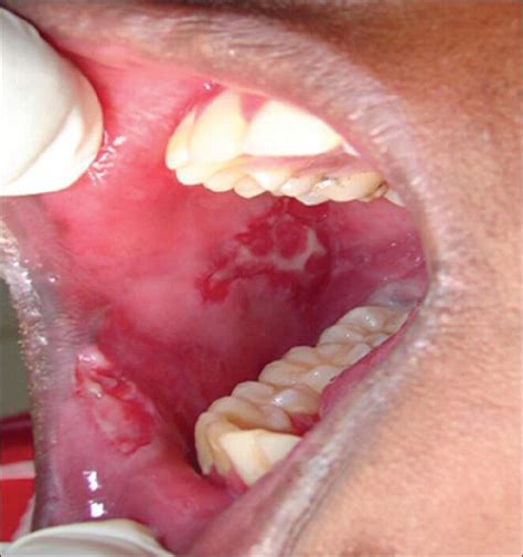 Common Oral Lesions Buccal Mucosa