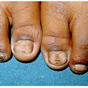Involvement of bilateral big toenails with habit tic deformity. | Download Scientific Diagram