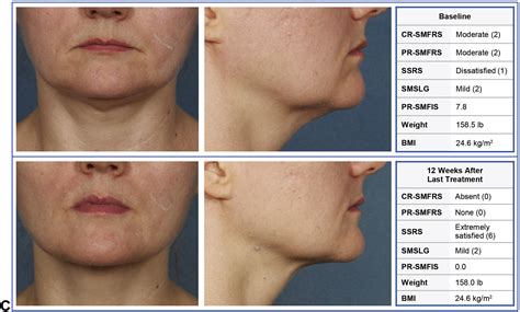 ATX-101 for reduction of submental fat: A phase III randomized controlled trial - Journal of the ...