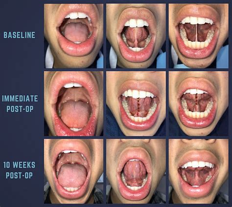 Assessment Of Posterior Tongue Mobility Using, 47% OFF