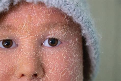 What is harlequin-type ichthyosis, the strange ‘fish skin’ disease? | Science | EL PAÍS English