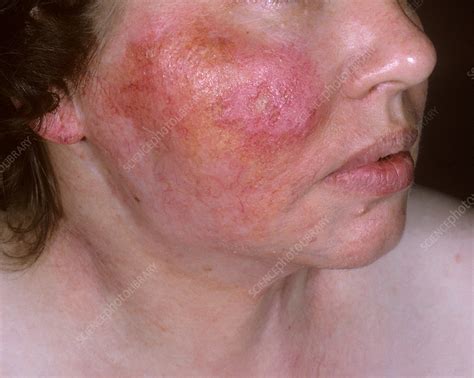 Cutaneous tuberculosis - Stock Image - C034/8799 - Science Photo Library