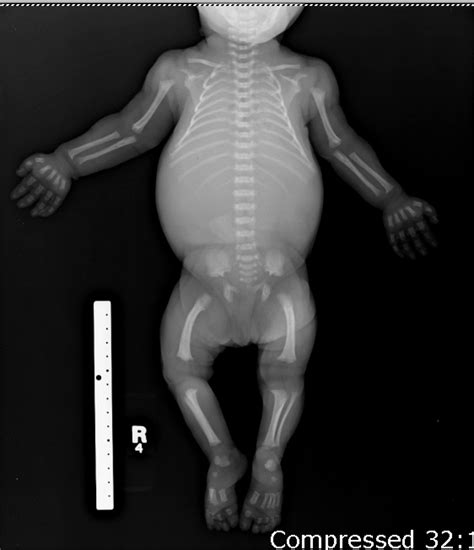 Achondroplasia; Severe Achondroplasia with Developmental Delay and ...