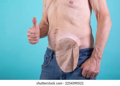 Stoma Care Health Life Stoma Stock Photo 2254390521 | Shutterstock