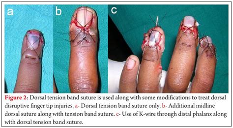 Finger tip injury; nail bed laceration; partial nail plate avulsion; complete nail plate ...