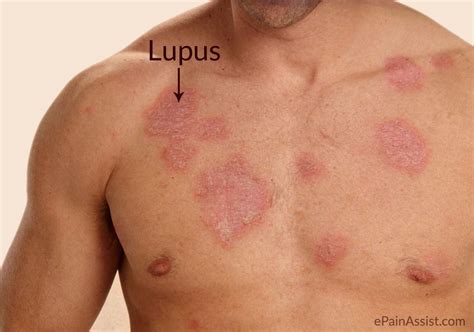 Kenali Gejala Penyakit Lupus dan Pengobatannya - Sulselekspres.com