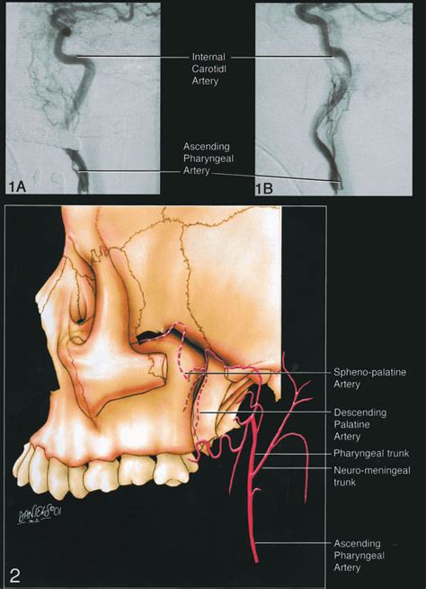 A and B, Anteroposterior (A) and lateral (B) angiograms depict rare... | Download Scientific Diagram