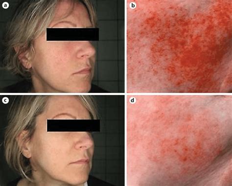 Patient with erythrosis and fine telangiectasia of the cheeks. Before... | Download Scientific ...