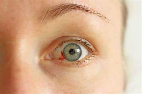 Corneal Laceration: Causes, Symptoms, Diagnosis And Treatment - accuspire