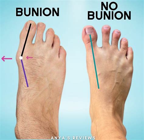 Bunions: Symptoms, Causes, Diagnosis, And Treatment, 51% OFF