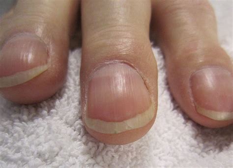 Nail Clubbing : Définition, causes et diagnostic