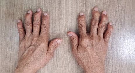 Hand Surgery for Rheumatoid Arthritis: What You Need to Know