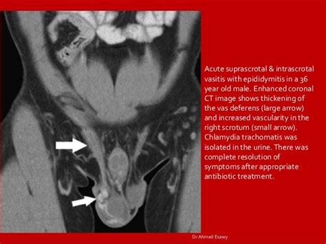 Imaging vastitis differentitis funiculitis seminal vesiculitis Dr Ahm…