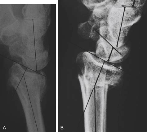 Osteotomies for Distal Radius Malunions: Intra- and Extra-articular | Musculoskeletal Key