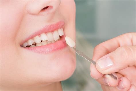 Pros And Cons Of Choosing Dental Veneers | Dr. Alex Midtown NYC Cosmetic Dentist