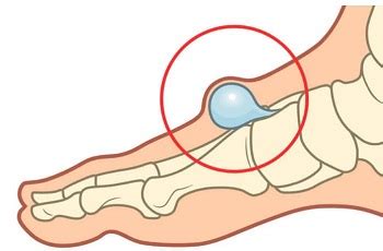 Lump On Top Of Foot: Common Causes & Treatment