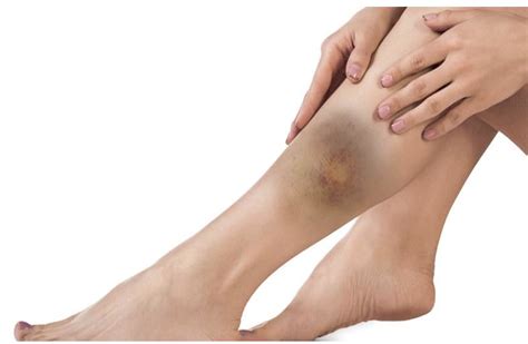 Condition Spotlight: Soft Tissue Injuries | Watsonia Podiatry