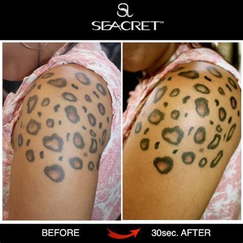 tca peel for tattoo removal before and after pictures - autocare5a7f9c7