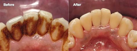 What is Non-Surgical Periodontal Therapy? – Britten Perio