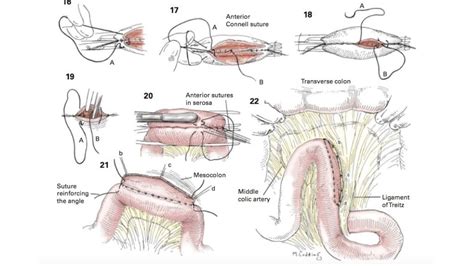 Gastric Perforation