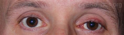 Conjunctival Lymphoma