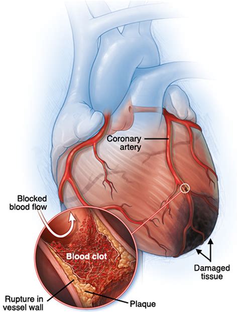 Myocardial Infarct - Pictures