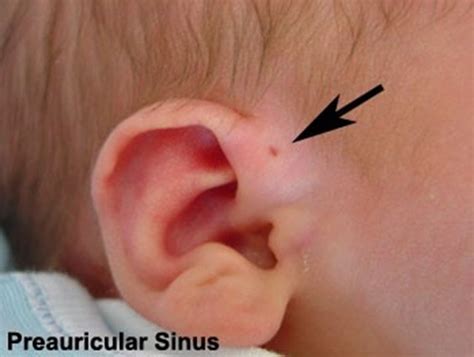 preauricular cyst excision