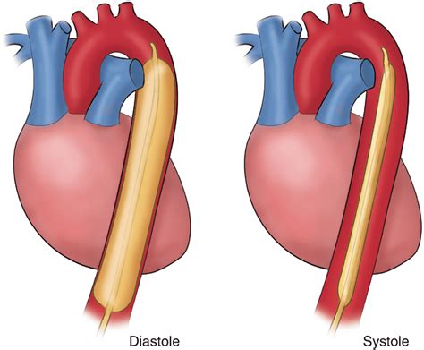 Intra Aortic Balloon Pump Heart