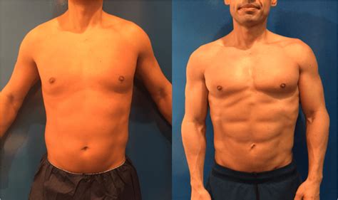 Before & After: Male Liposuction Results | Neinstein Plastic Surgery