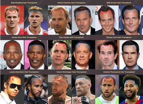 Top 48 image celebrities with hair transplants - Thptnganamst.edu.vn